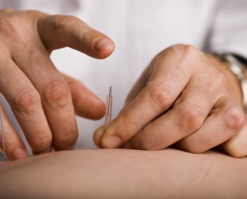 Your Post Christmas Detox And Japanese Needle Therapy - Tapping in acupuncture needle
